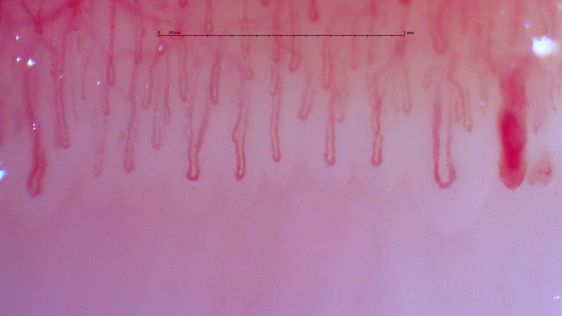 Capillaroscopy example 1