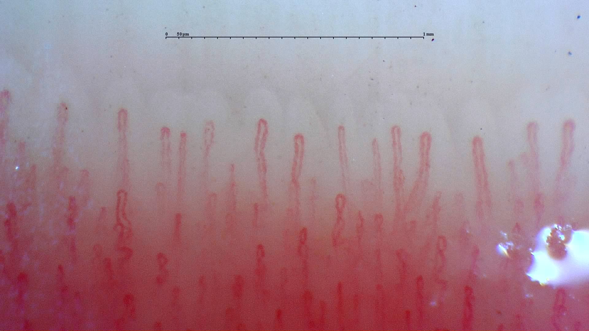 Capillaroscopy example 2