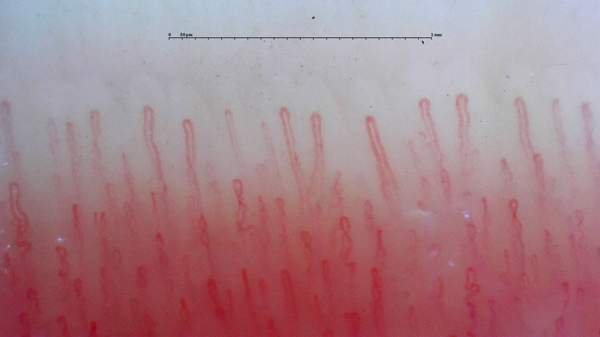 Capillaroscopy example 3