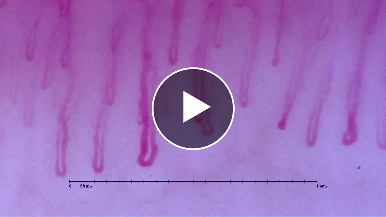 Capillaroscopy with Smart G-Scope